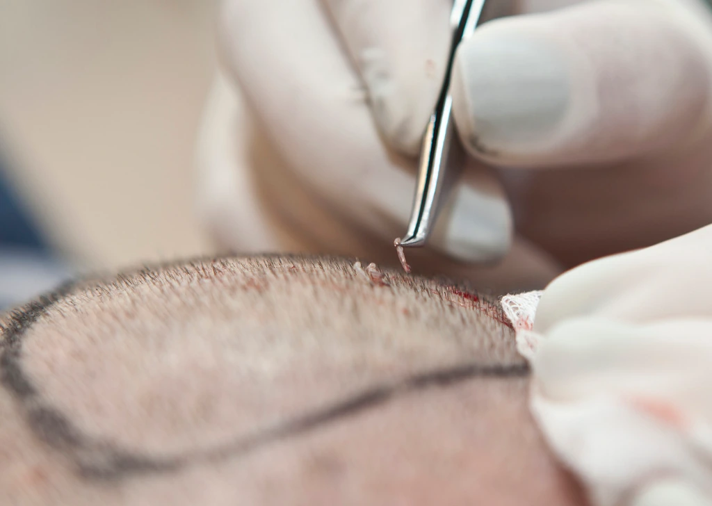 What is DHI Hair Transplant?